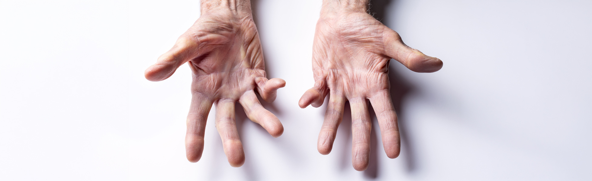 Dupuytren’s Disease